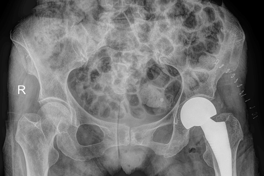 hình x quang gãy cổ xương đùi