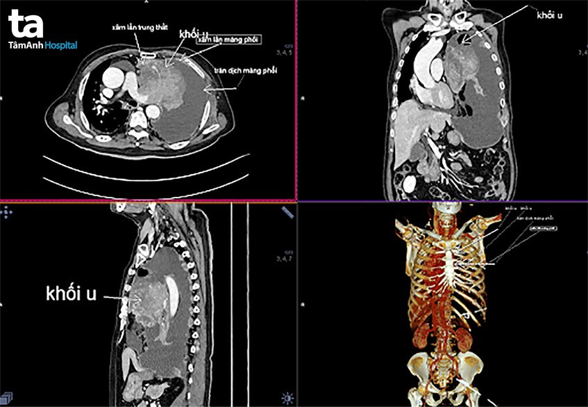 Hình ảnh CT cho thấy bệnh nhân bị tràn dịch màng phổi bên trái lượng lớn, hạch trung thất lớn ngay sau khí quản.