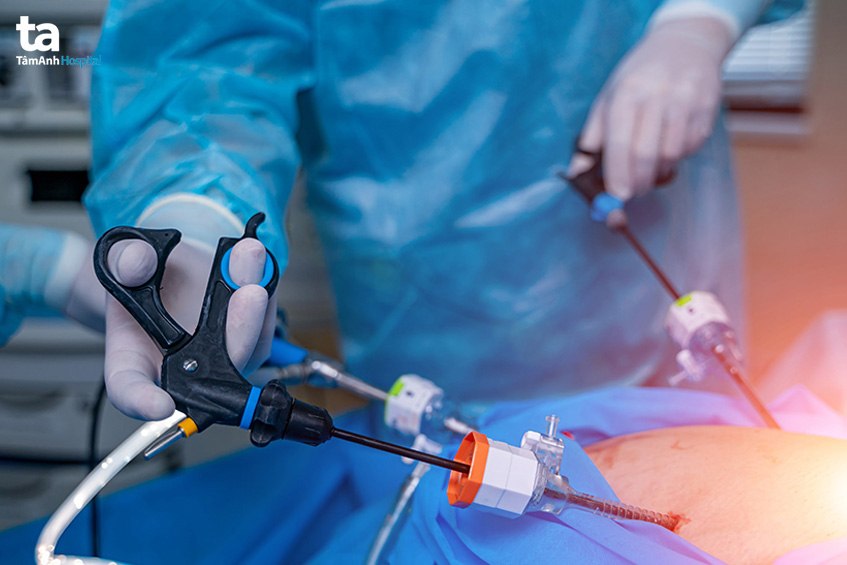 phẫu thuật bằng mổ nội soi