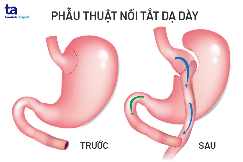 phẫu thuật nội tắt dạ dày