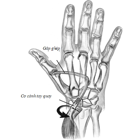 Hình 7: Sử dụng cơ cánh tay quay làm động lực phục hồi ngón I (Hand surgery, 2004)
