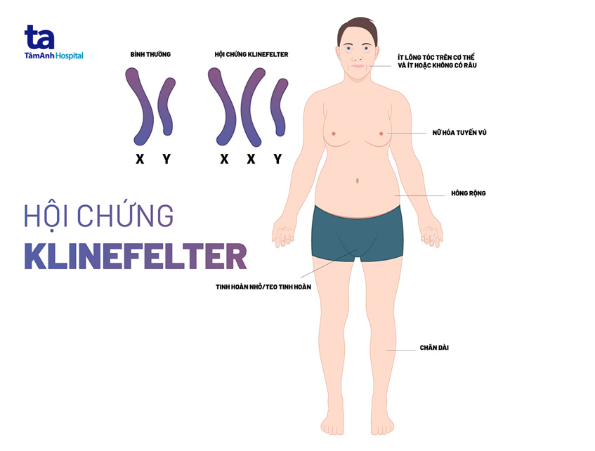 vô sinh do mắc hội chứng klinefelter