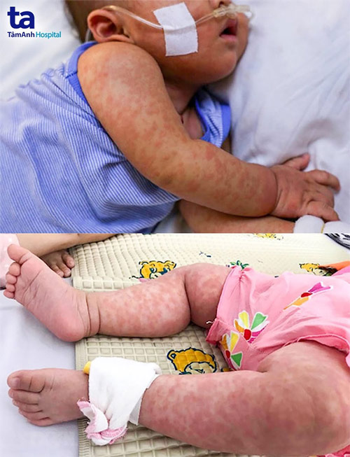 bệnh nhi tại bv tâm anh