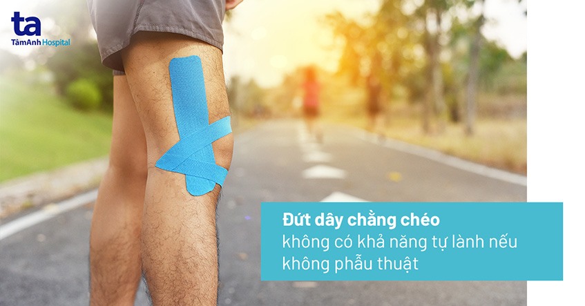 Đứt dây chằng chéo có đi được không? Cần làm gì khi gặp chấn thương