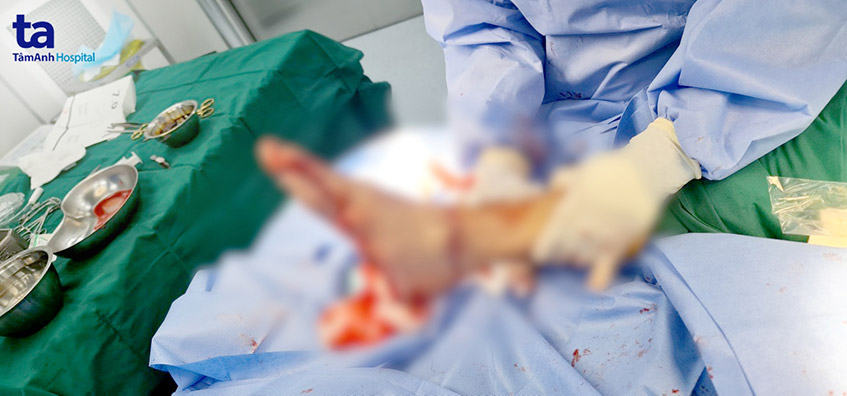 phẫu thuật cứu sống bàn chân