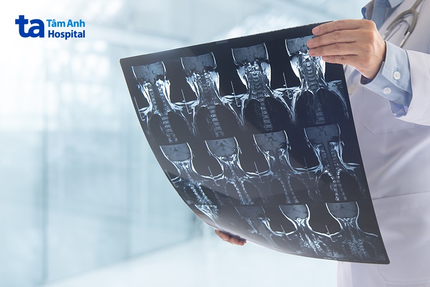 chẩn đoán hình ảnh bệnh thoái hóa cột sống