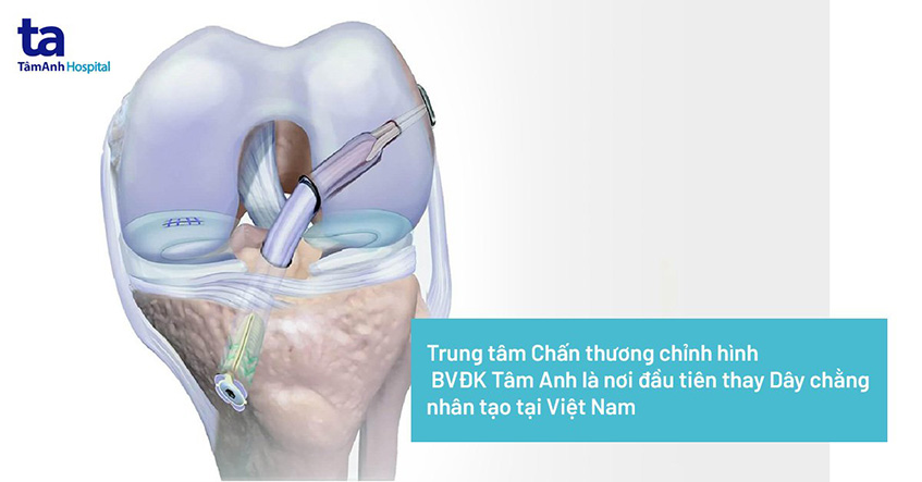Dây chằng nhân tạo và những điều cần biết