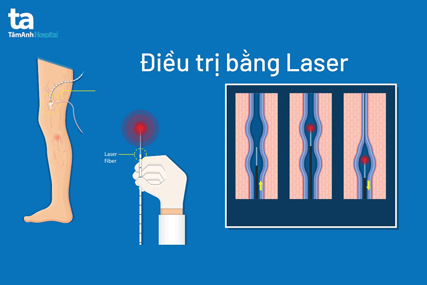 điều trị giãn tĩnh mạch chi dưới bằng laser