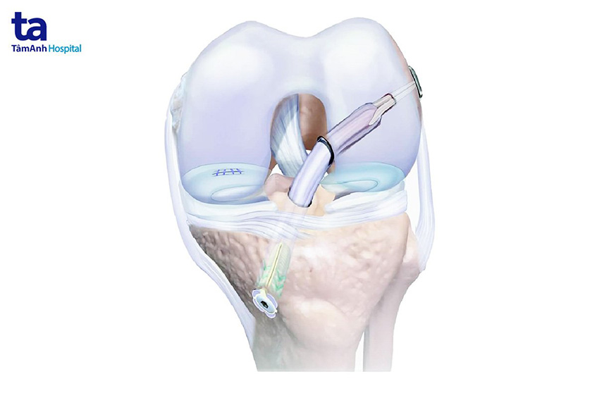 hình ảnh dây chằng nhân tạo