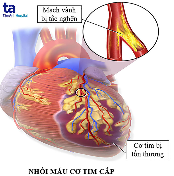 Hình ảnh minh họa nhồi máu cơ tim