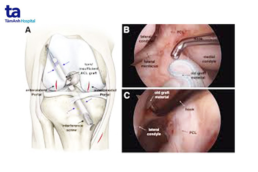 phẫu thuật thay dây chằng nhân tạo