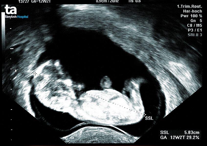 Xem những hình ảnh siêu âm 2D thai nhi, giúp cho bạn cảm nhận được sự sống động và kỳ diệu của cuộc đời trong bụng mẹ.