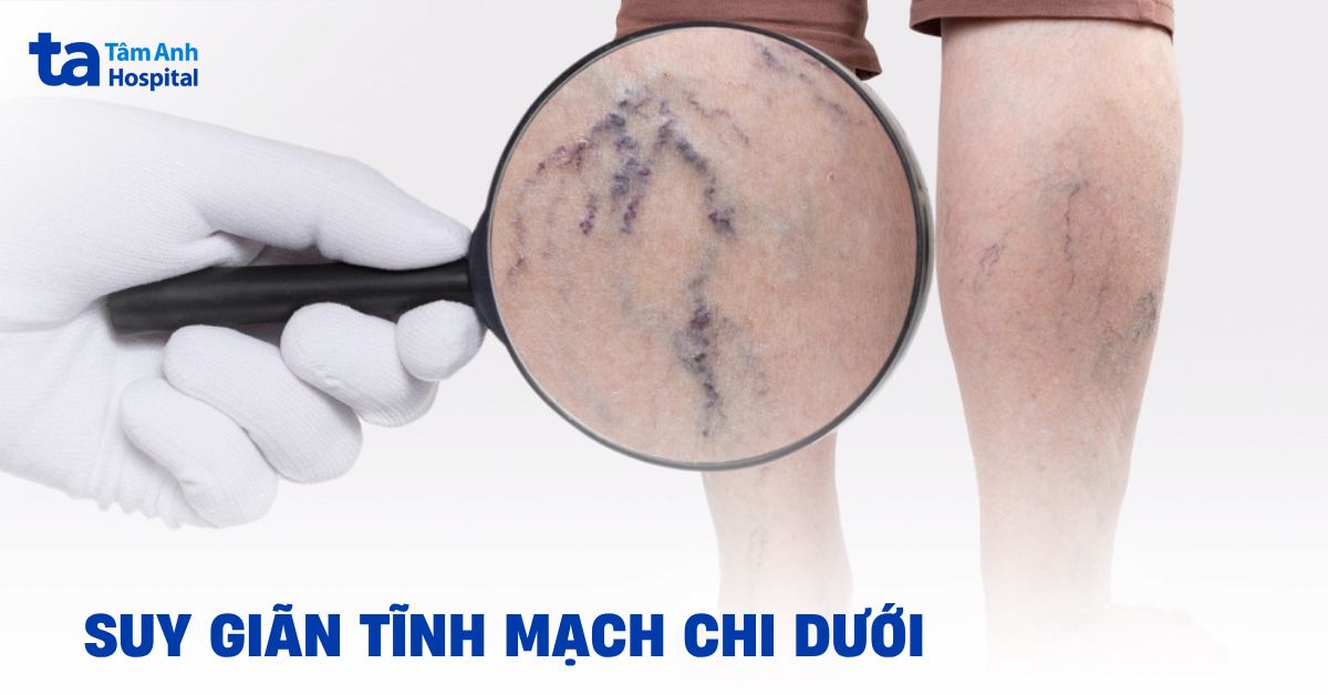 suy giãn tĩnh mạch chi dưới