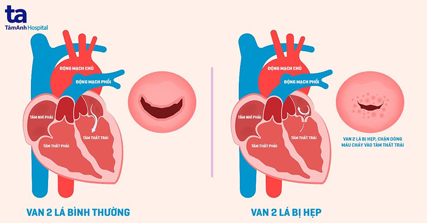 Tầm quan trọng và hình ảnh của điện tâm đồ nhồi máu cơ tim