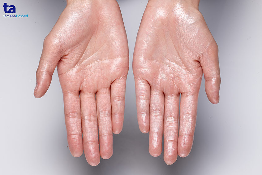 Chứng bệnh gây ảnh hưởng đến nhiều người