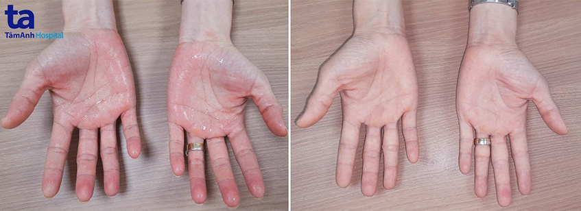Chứng đổ mồ hôi tay trước và sau khi điều trị