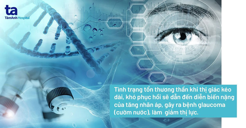Bệnh tăng nhãn áp kéo dài có thể tiến triển thành cườm nước, gây mù