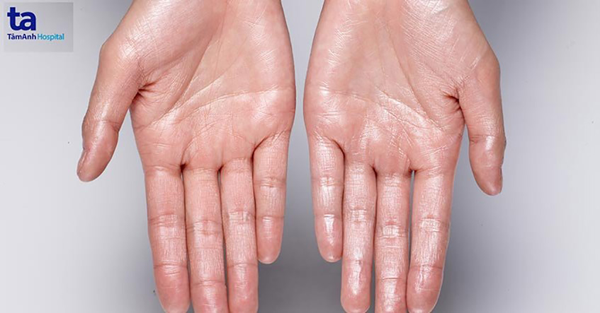 Phẫu thuật đốt hạch giao cảm điều trị chứng đổ mồ hôi tay
