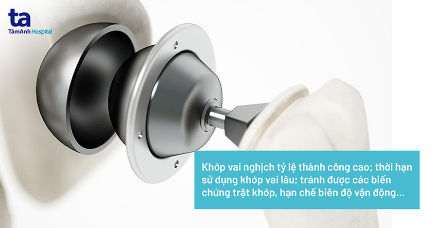 Phẫu thuật thay khớp vai nghịch