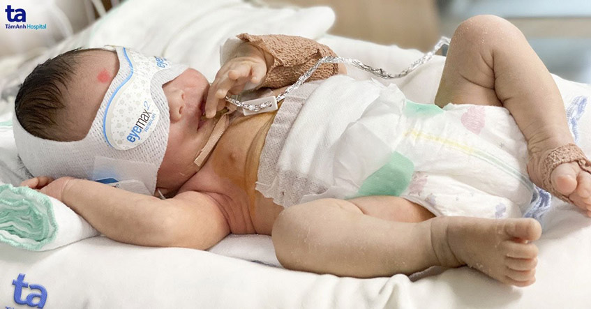 60 phút phẫu thuật cứu trẻ sơ sinh bị ruột xoay bất toàn hiếm gặp