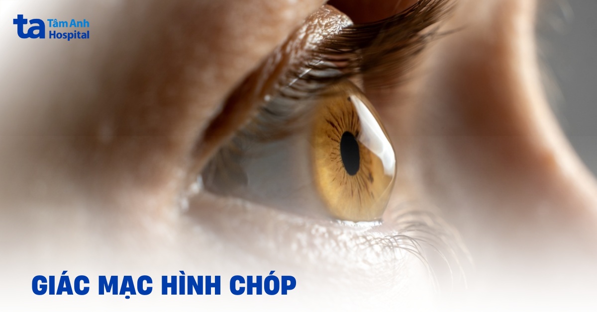 Giác mạc hình chóp và các phương pháp khắc phục