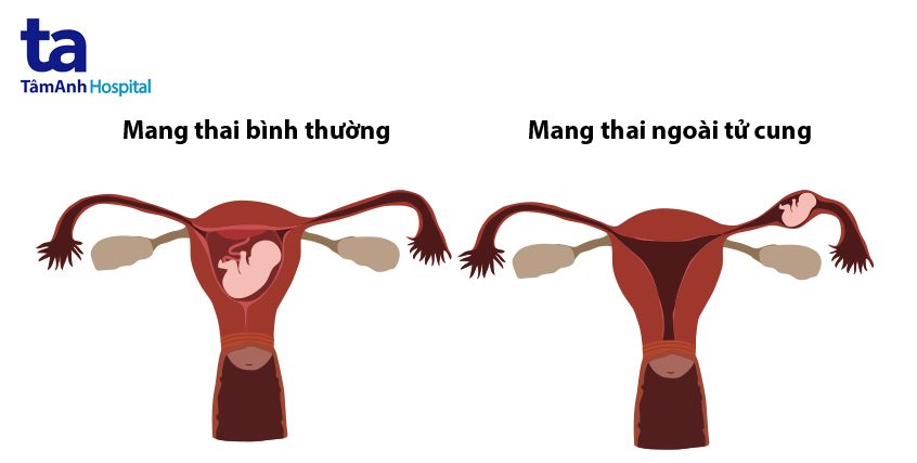 mang thai ngoài tử cung