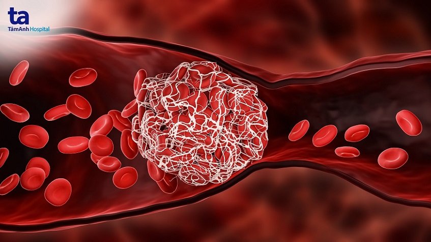 Cục máu đông làm tắc nghẽn mạch máu