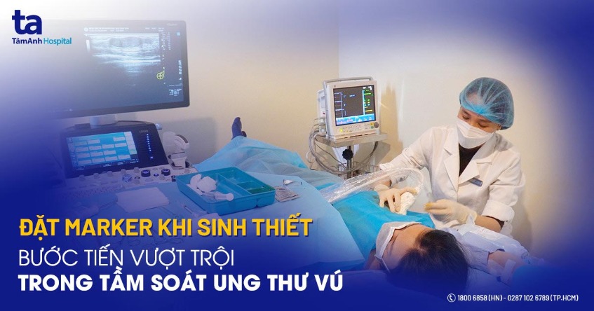 đặt marker khi sinh thiết ung thư vú