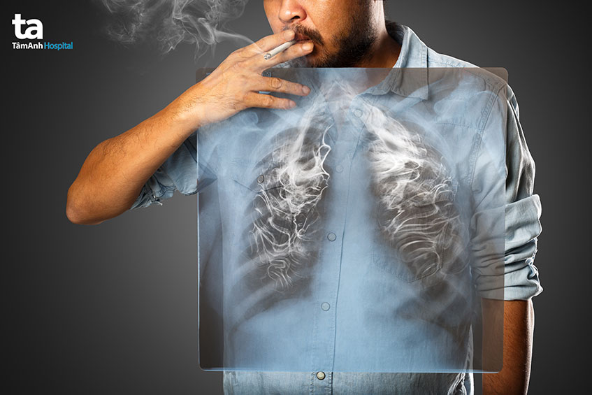 ung thư bộ phận phổi