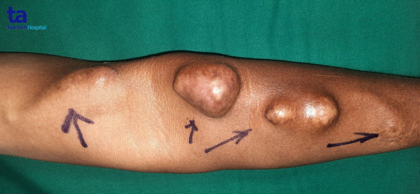 các đoạn phình mạch máu