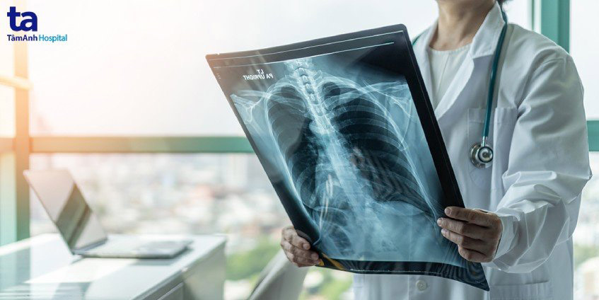 chụp x quang phổi cho bệnh nhân