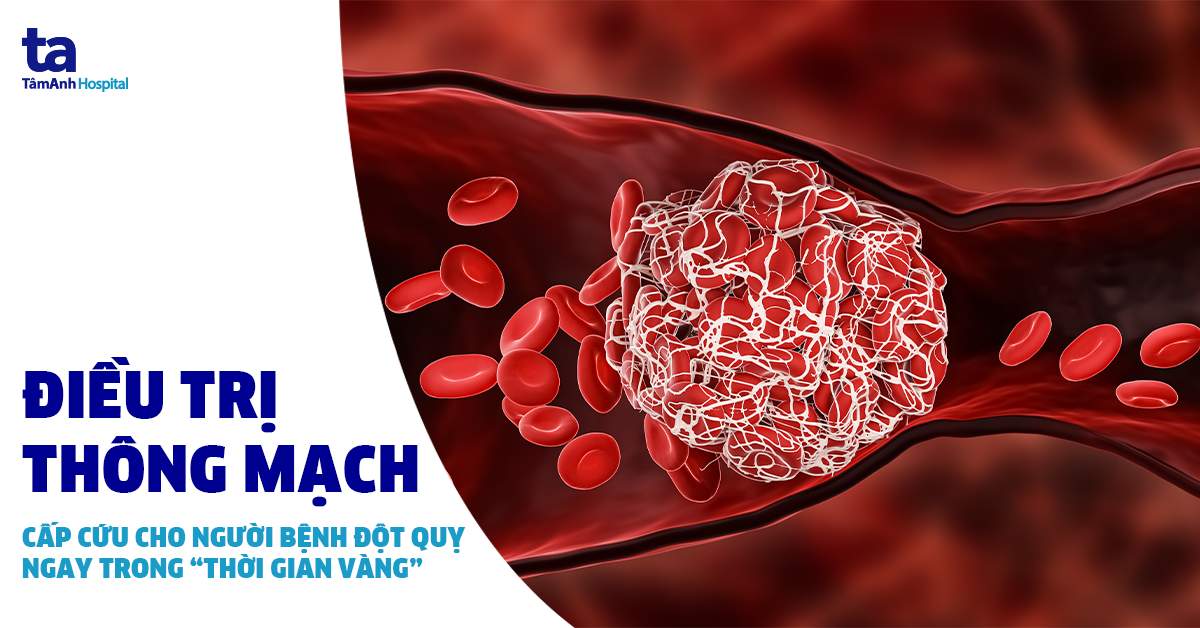 Kỹ thuật mới thông mạch cấp cứu đột quỵ trong “giờ vàng”