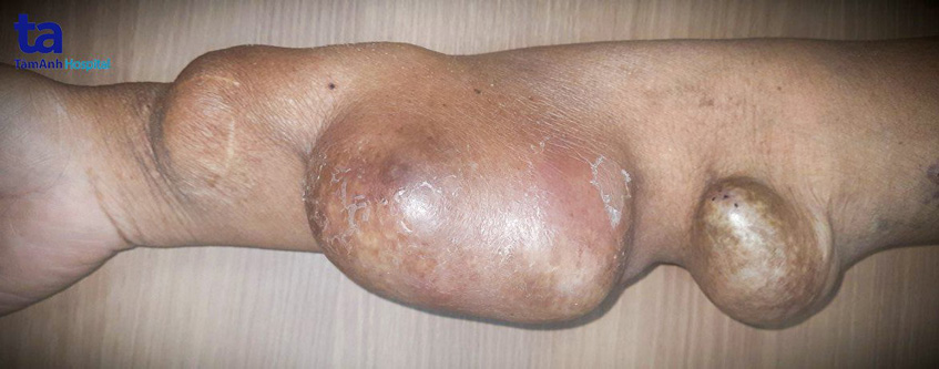 khối phình mạch máu