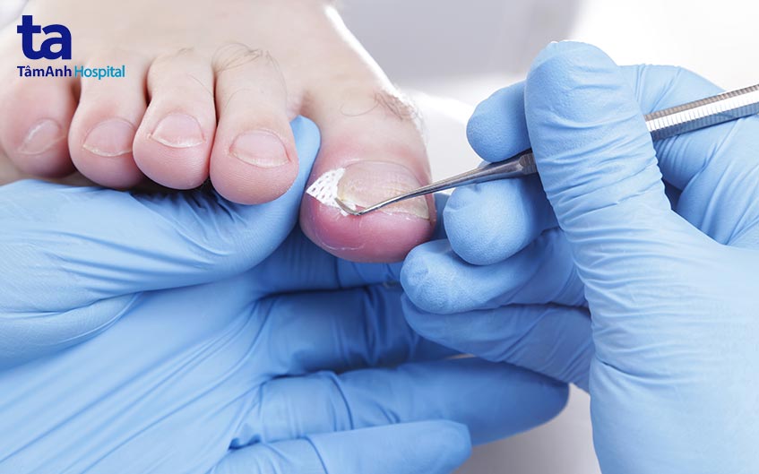 xử lý bị móng quặp