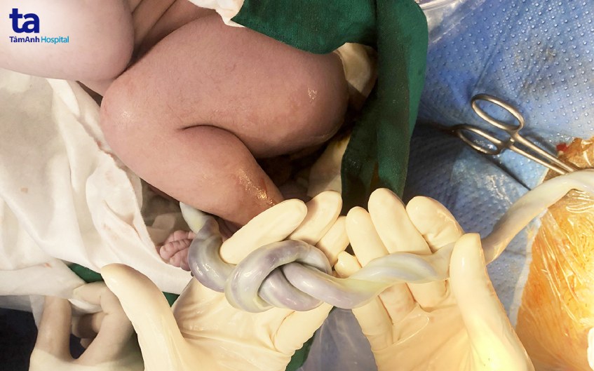 cận cảnh bút thắt thai nhi ở tuần 39