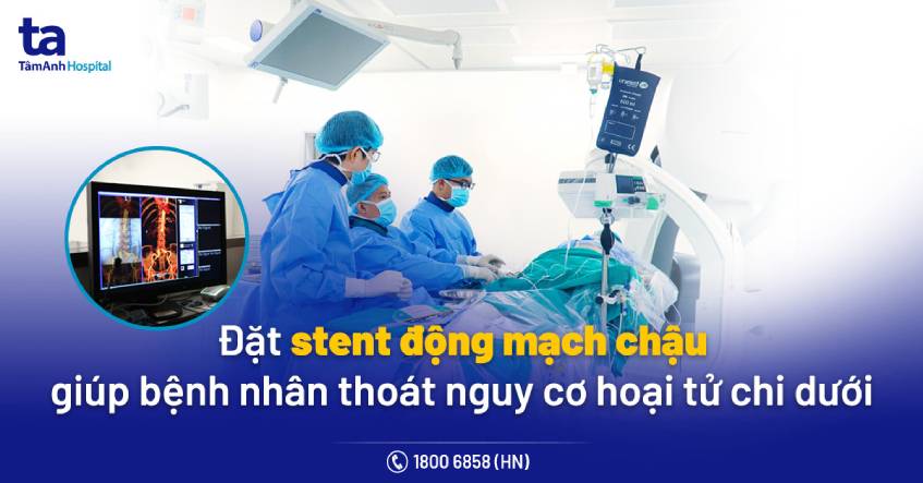 dat stent dong mach chau