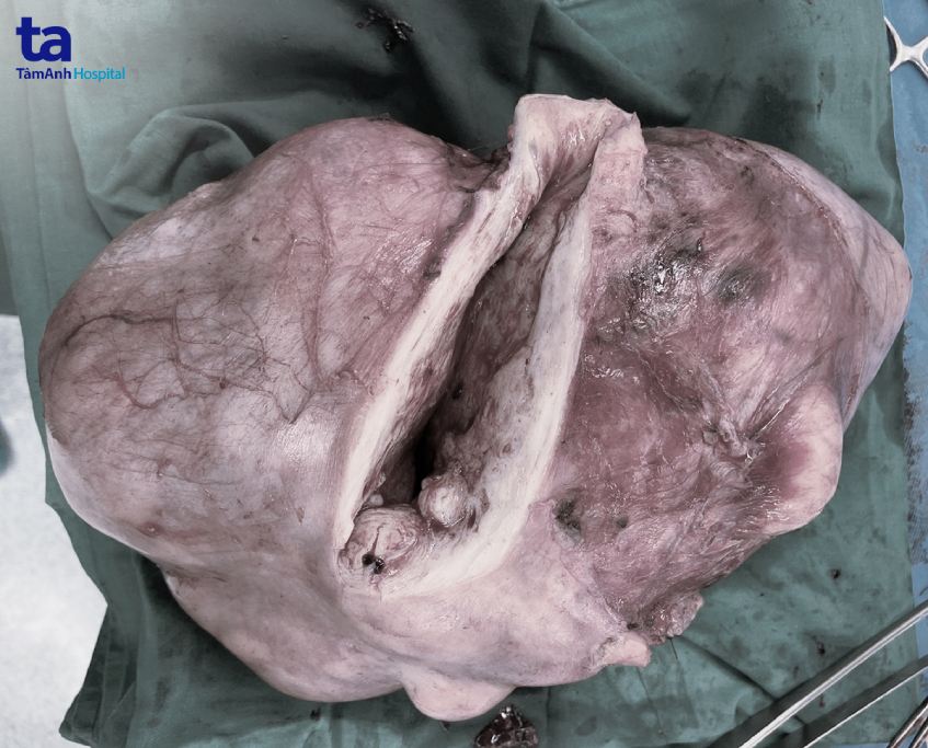 khối u xơ tử cung nặng 32kg