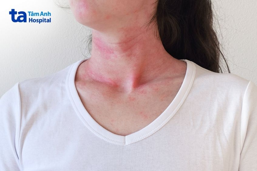 phát ban cảnh báo sốc phản vệ