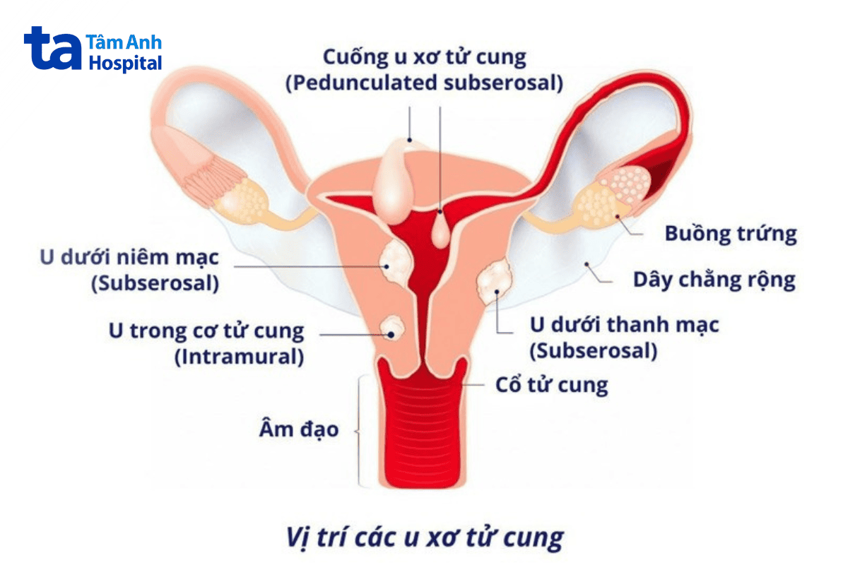hình ảnh minh hoạt về vị trí u xơ tử cung
