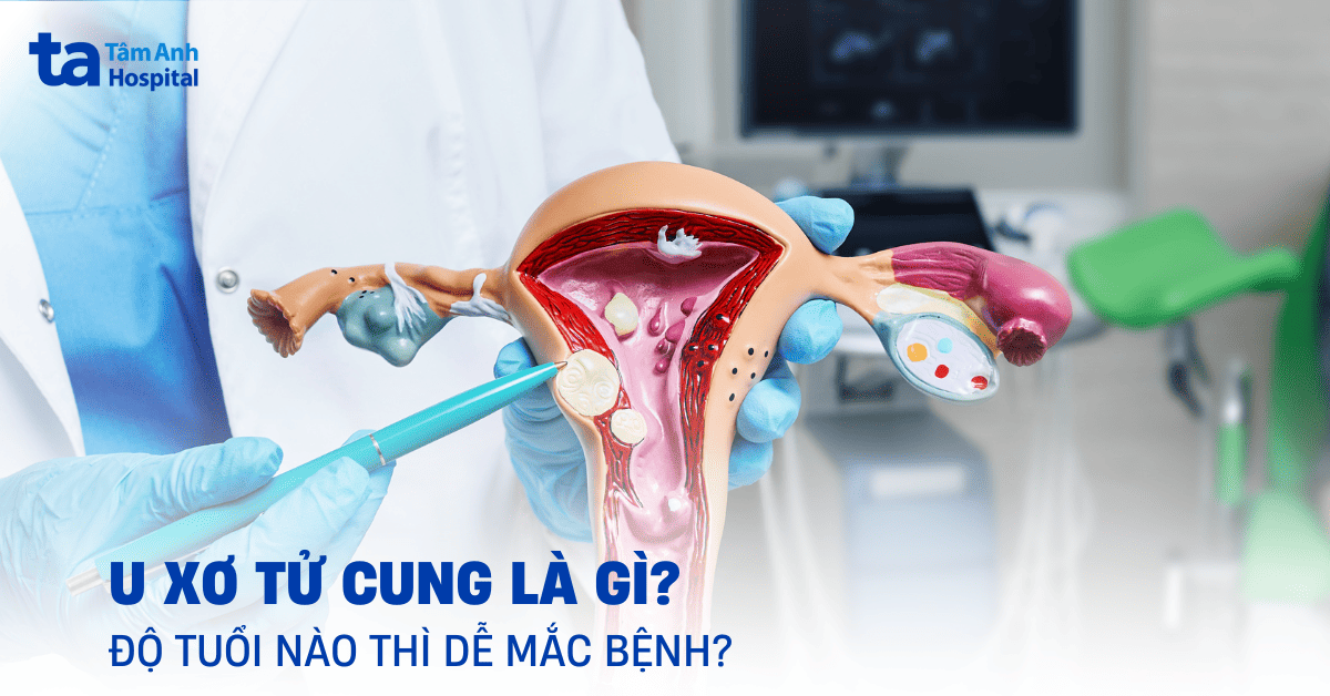 u xơ tử cung là gì