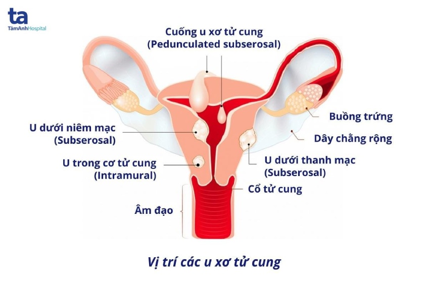 vị trí cá khối u xơ tử cung