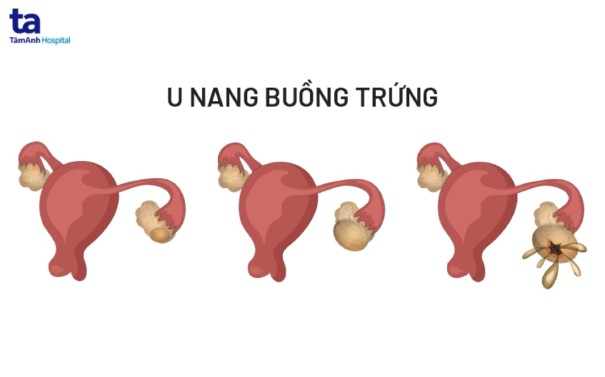 vỡ u nang cũng là nguyên nhân
