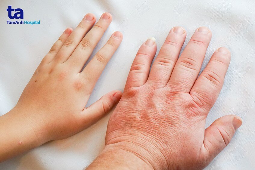 benh to dau chi la gi