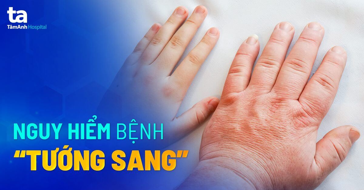Bệnh to đầu chi: Dấu hiệu, nguyên nhân, biến chứng và chẩn đoán