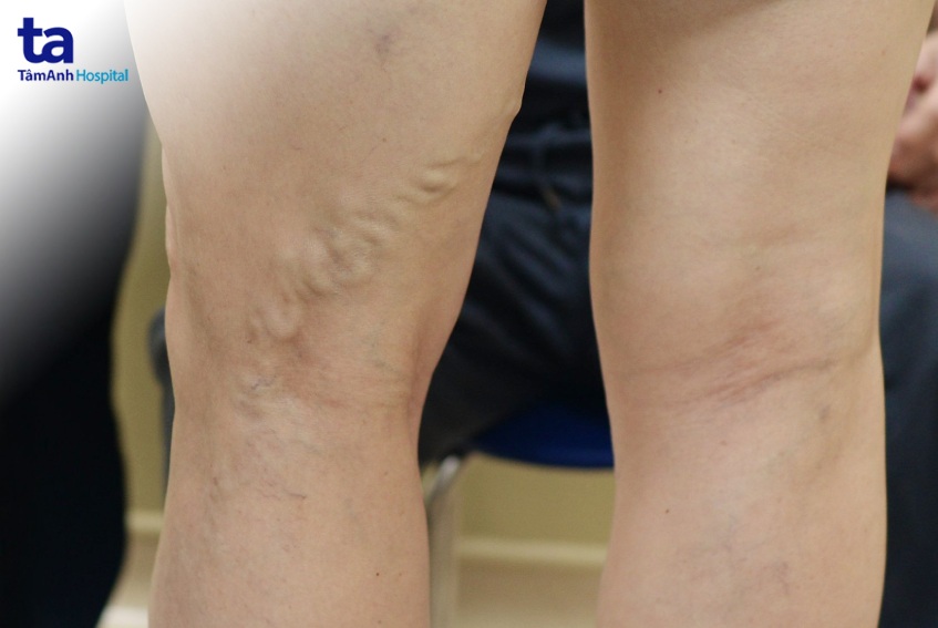 suy giãn tĩnh mạch cấp độ 3