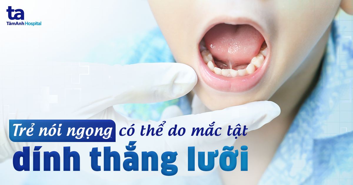 Trẻ nói ngọng có phải do dính thắng lưỡi không?