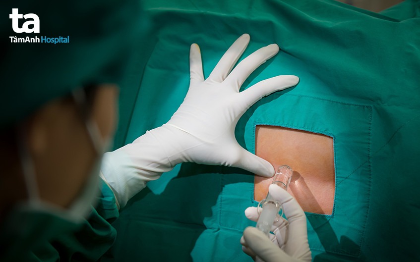 tiêm thuốc mê vào tủy sống