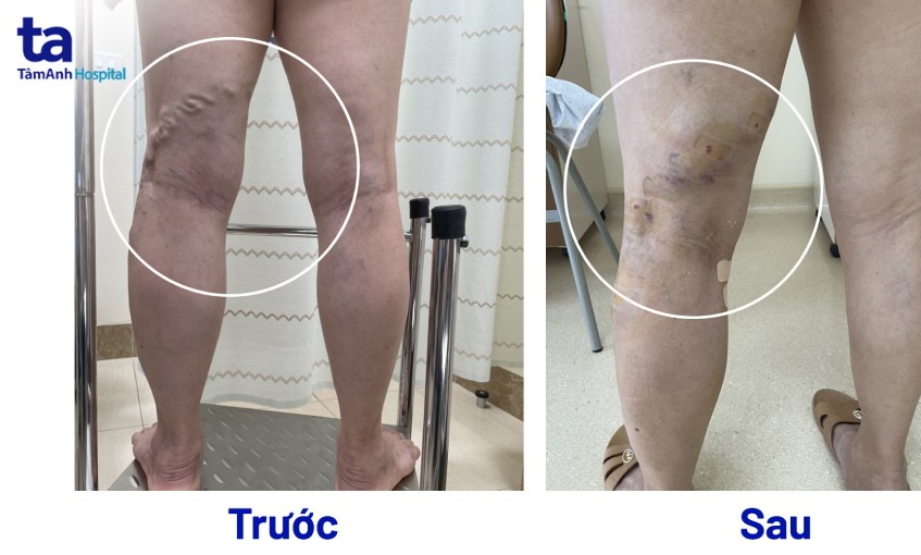 trước và sau khi can thiệp