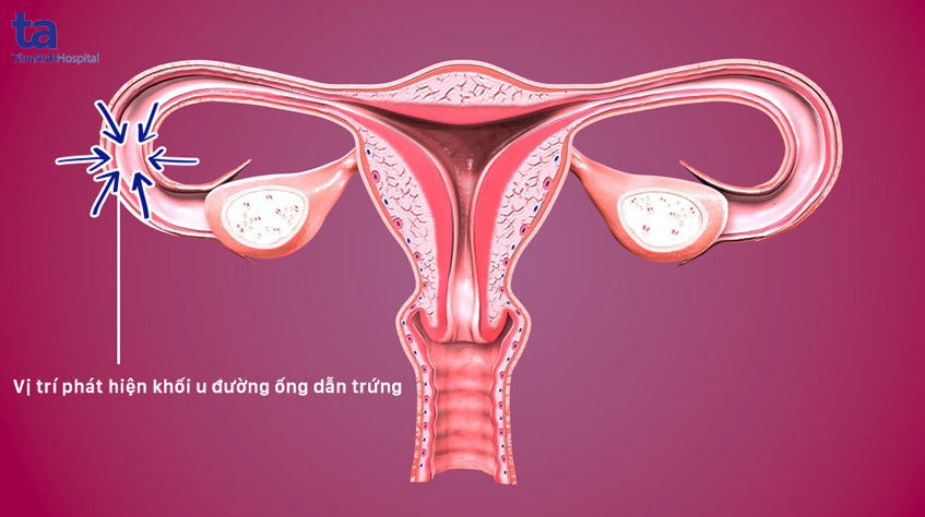 vị trí phát hiện khối u