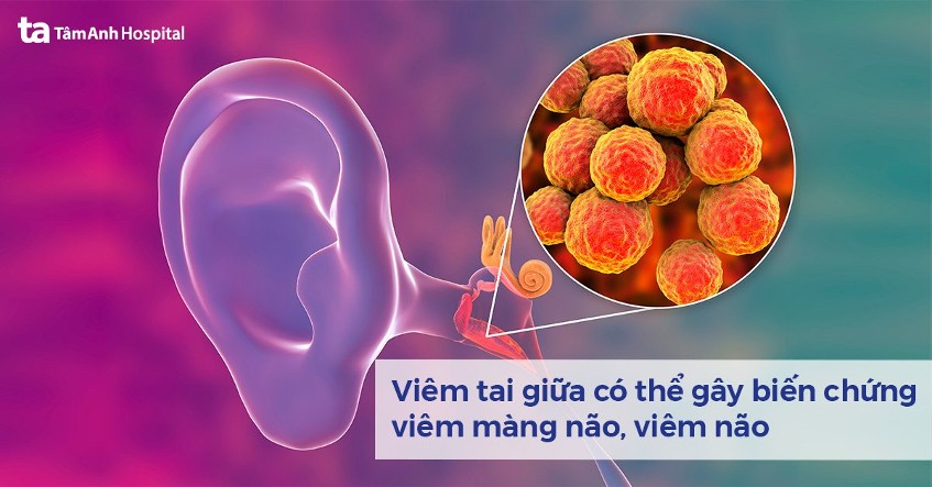 Viêm tai giữa: Nguyên nhân, dấu hiệu, chẩn đoán và cách điều trị